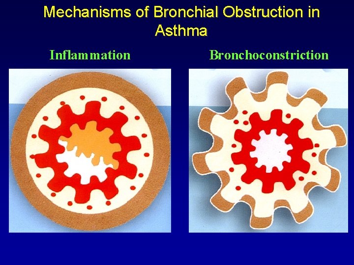 Mechanisms of Bronchial Obstruction in Asthma Inflammation Bronchoconstriction 