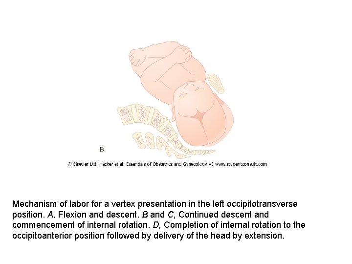 Mechanism of labor for a vertex presentation in the left occipitotransverse position. A, Flexion