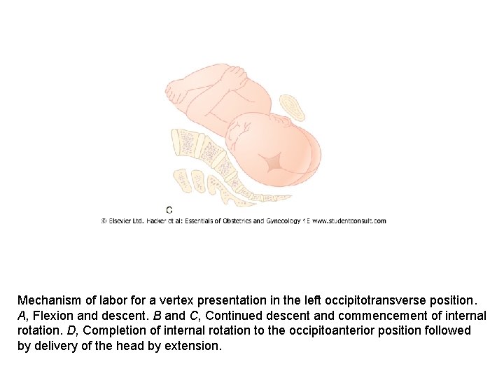Mechanism of labor for a vertex presentation in the left occipitotransverse position. A, Flexion