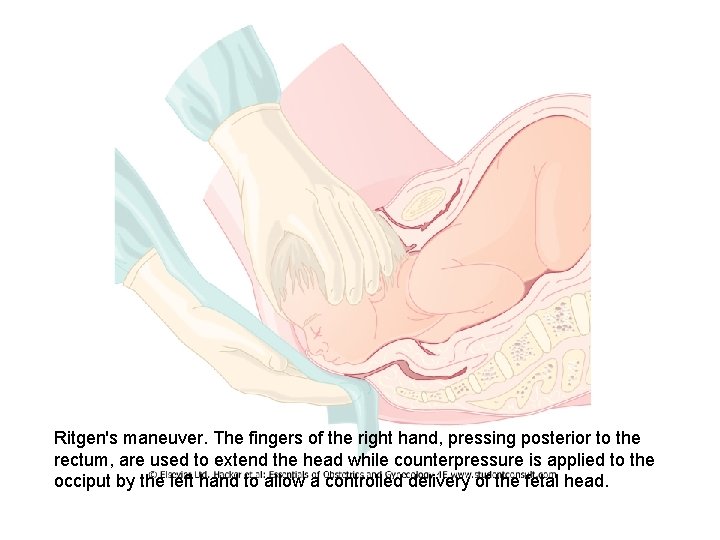 Ritgen's maneuver. The fingers of the right hand, pressing posterior to the rectum, are