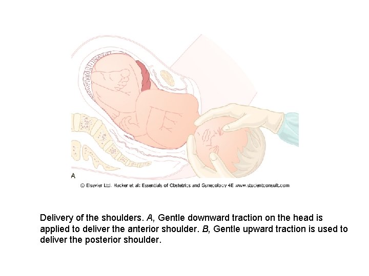 Delivery of the shoulders. A, Gentle downward traction on the head is applied to
