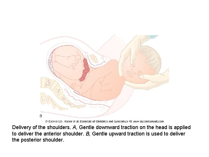 Delivery of the shoulders. A, Gentle downward traction on the head is applied to