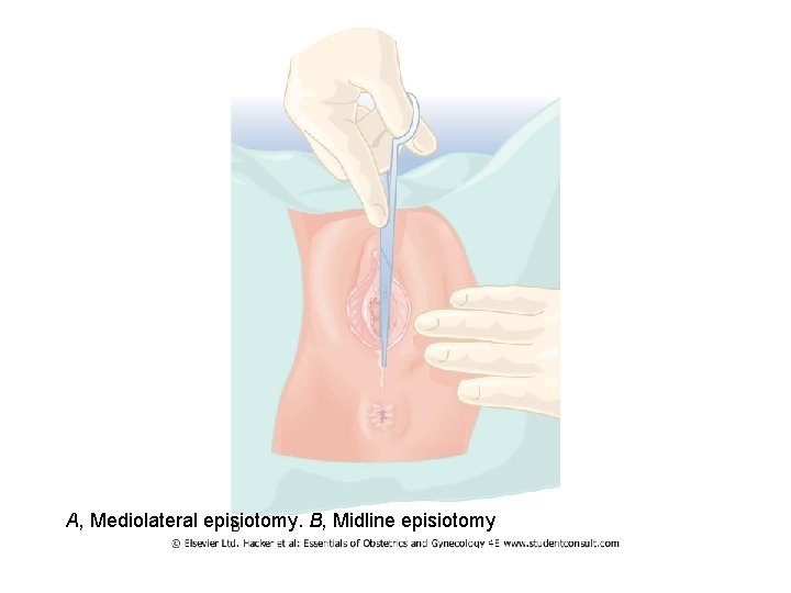 A, Mediolateral episiotomy. B, Midline episiotomy 