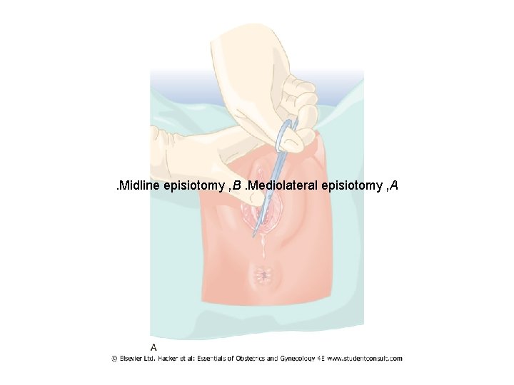. Midline episiotomy , B. Mediolateral episiotomy , A 