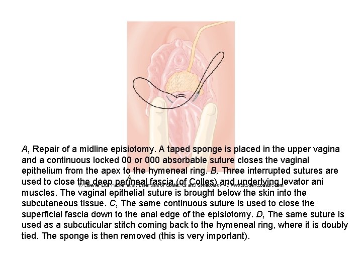 A, Repair of a midline episiotomy. A taped sponge is placed in the upper