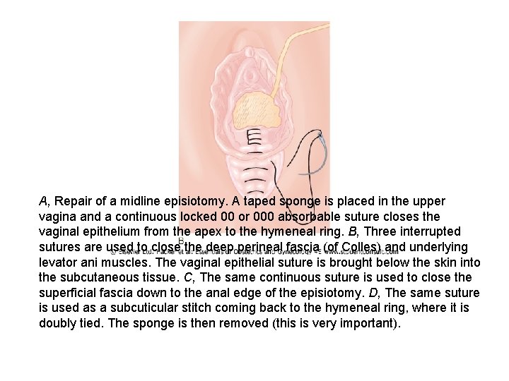 A, Repair of a midline episiotomy. A taped sponge is placed in the upper