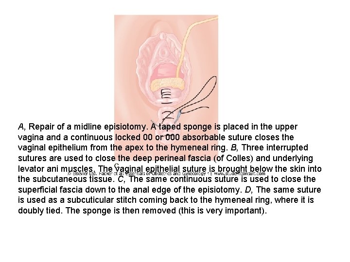 A, Repair of a midline episiotomy. A taped sponge is placed in the upper