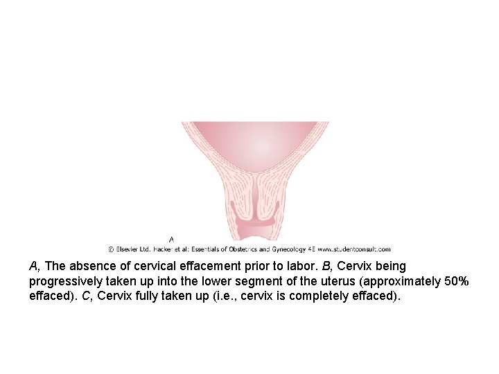 A, The absence of cervical effacement prior to labor. B, Cervix being progressively taken