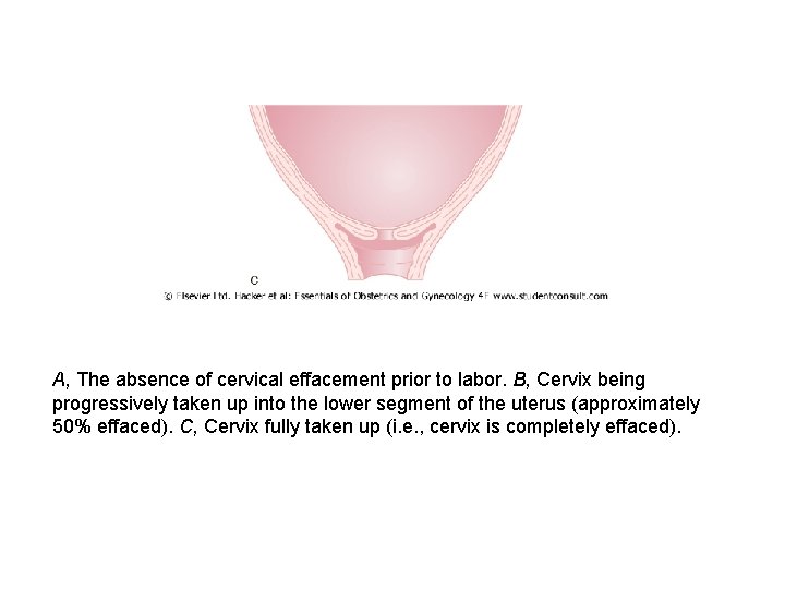 A, The absence of cervical effacement prior to labor. B, Cervix being progressively taken