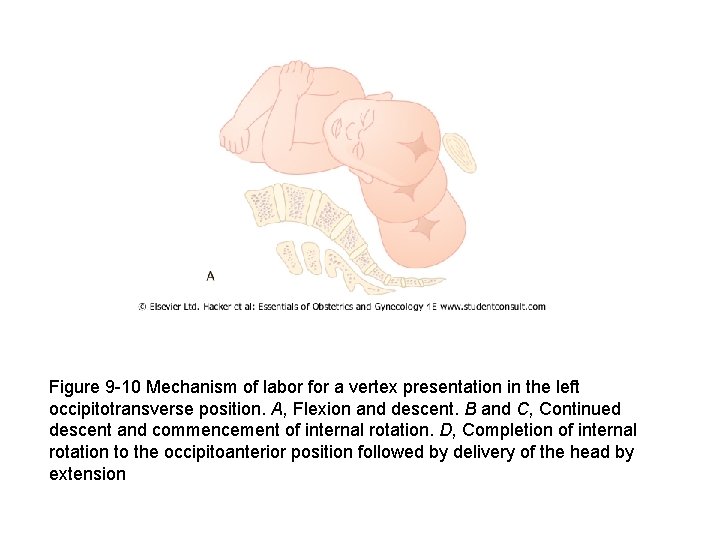 Figure 9 -10 Mechanism of labor for a vertex presentation in the left occipitotransverse