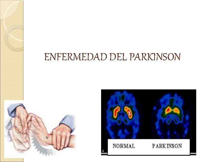 ENFERMEDAD DEL PARKINSON 