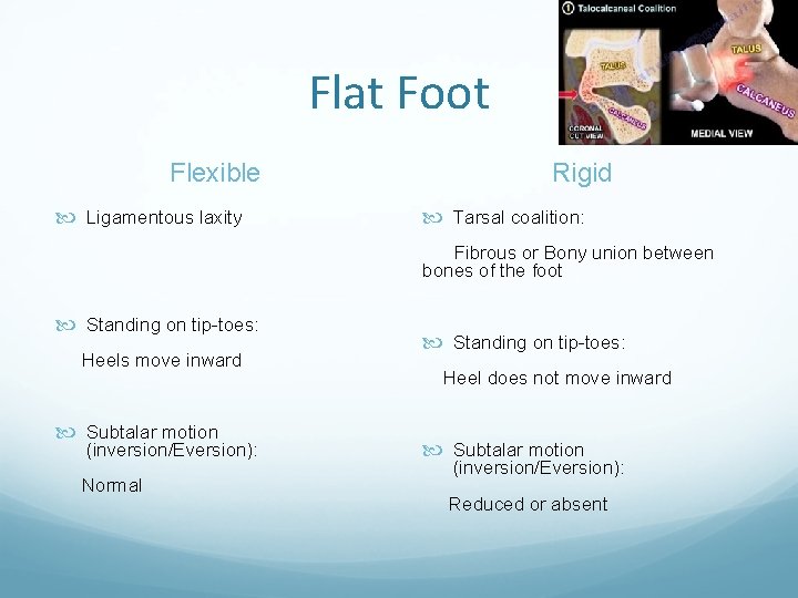 Flat Foot Flexible Ligamentous laxity Rigid Tarsal coalition: Fibrous or Bony union between bones