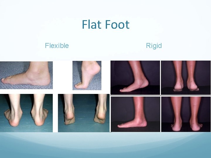 Flat Foot Flexible Rigid 
