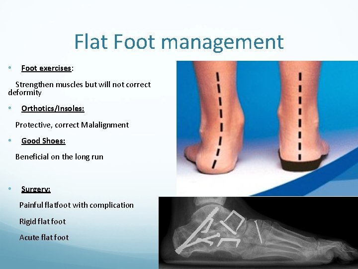 Flat Foot management • Foot exercises: Strengthen muscles but will not correct deformity •