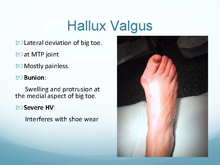 Hallux Valgus Lateral deviation of big toe. at MTP joint Mostly painless. Bunion: Swelling