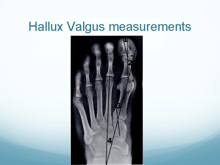 Hallux Valgus measurements 