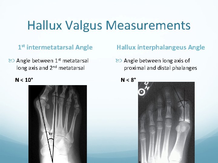 Hallux Valgus Measurements 1 st intermetatarsal Angle between 1 st metatarsal long axis and