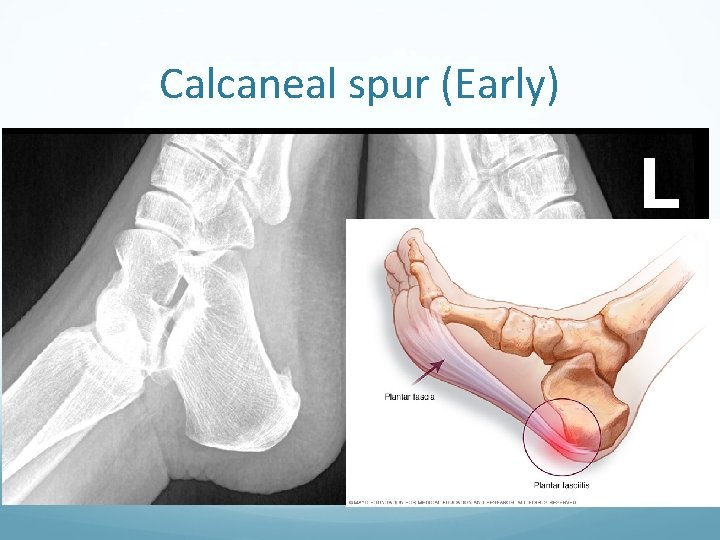 Calcaneal spur (Early) 