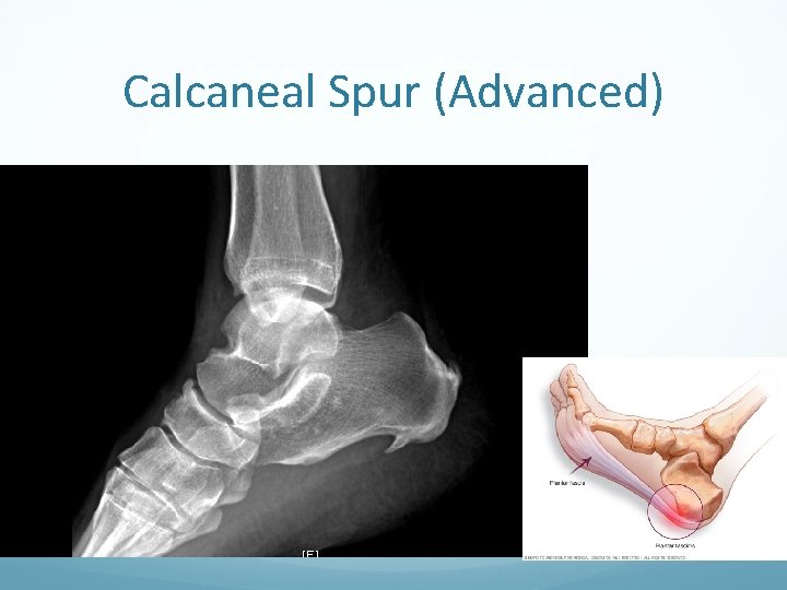 Calcaneal Spur (Advanced) 