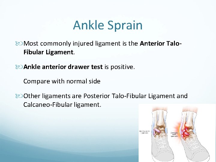 Ankle Sprain Most commonly injured ligament is the Anterior Talo. Fibular Ligament. Ankle anterior