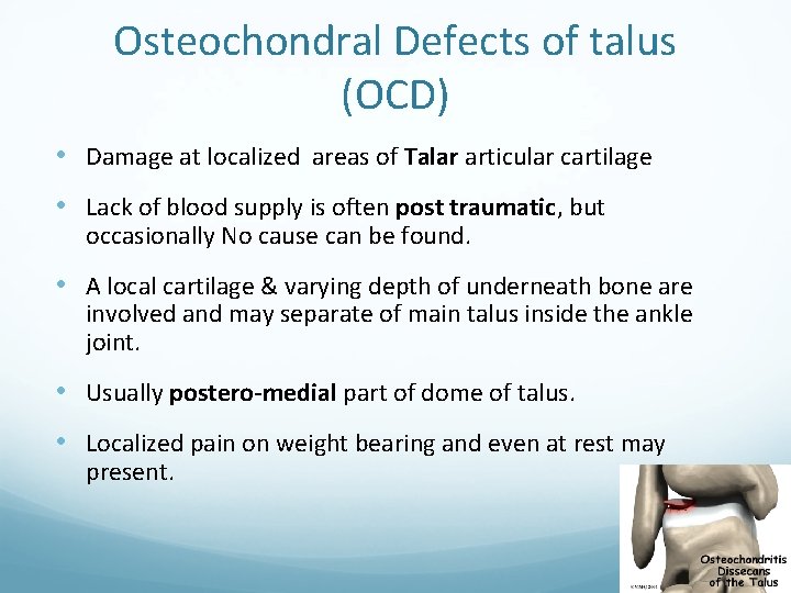 Osteochondral Defects of talus (OCD) • Damage at localized areas of Talar articular cartilage
