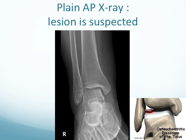 Plain AP X-ray : lesion is suspected 