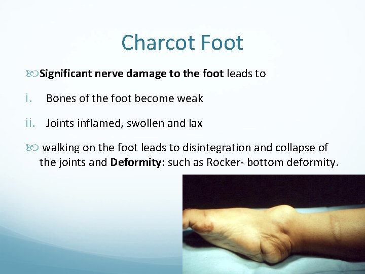 Charcot Foot Significant nerve damage to the foot leads to i. Bones of the