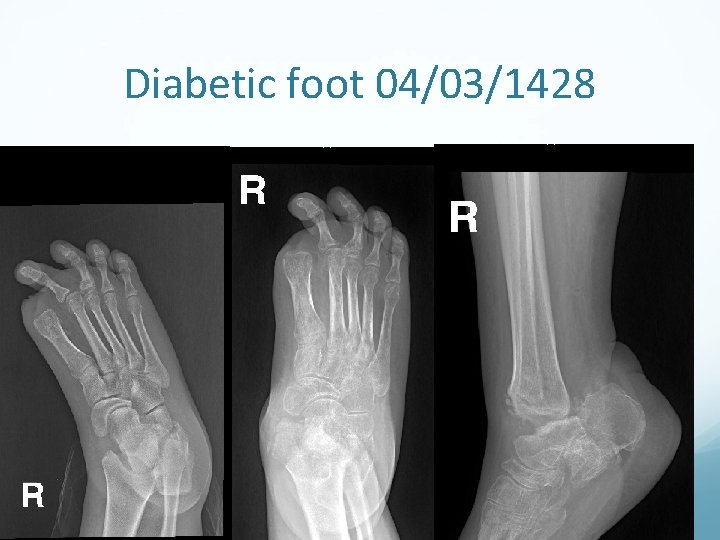 Diabetic foot 04/03/1428 