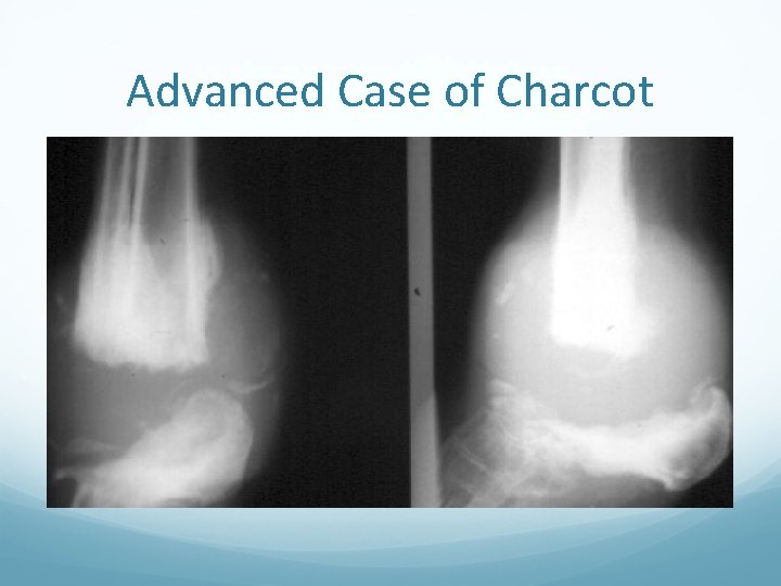 Advanced Case of Charcot 