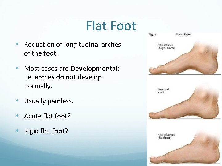 Flat Foot • Reduction of longitudinal arches of the foot. • Most cases are