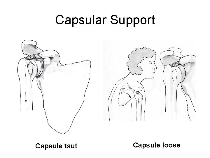 Capsular Support Capsule taut Capsule loose 