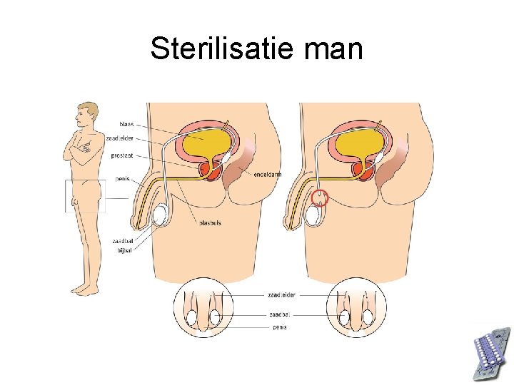 Sterilisatie man 