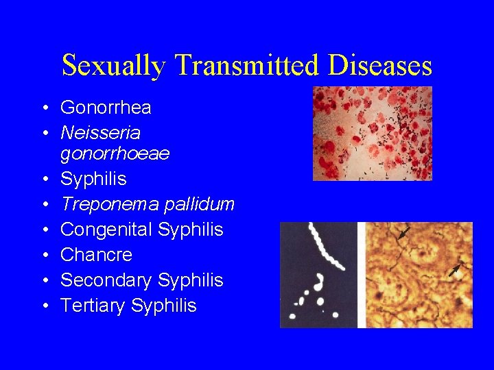 Sexually Transmitted Diseases • Gonorrhea • Neisseria gonorrhoeae • Syphilis • Treponema pallidum •