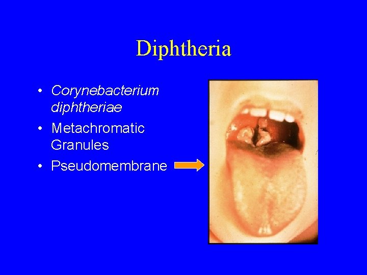 Diphtheria • Corynebacterium diphtheriae • Metachromatic Granules • Pseudomembrane 