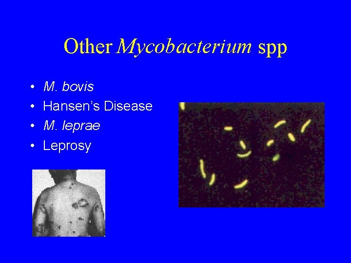 Other Mycobacterium spp • • M. bovis Hansen’s Disease M. leprae Leprosy 