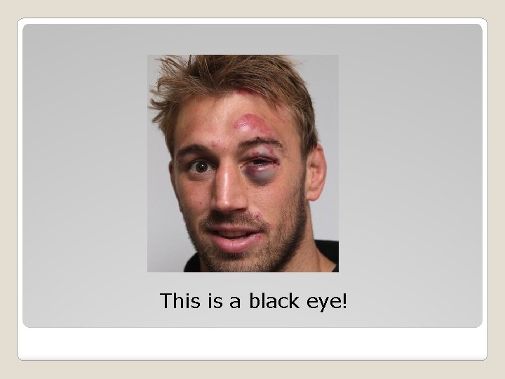This is a black eye! 