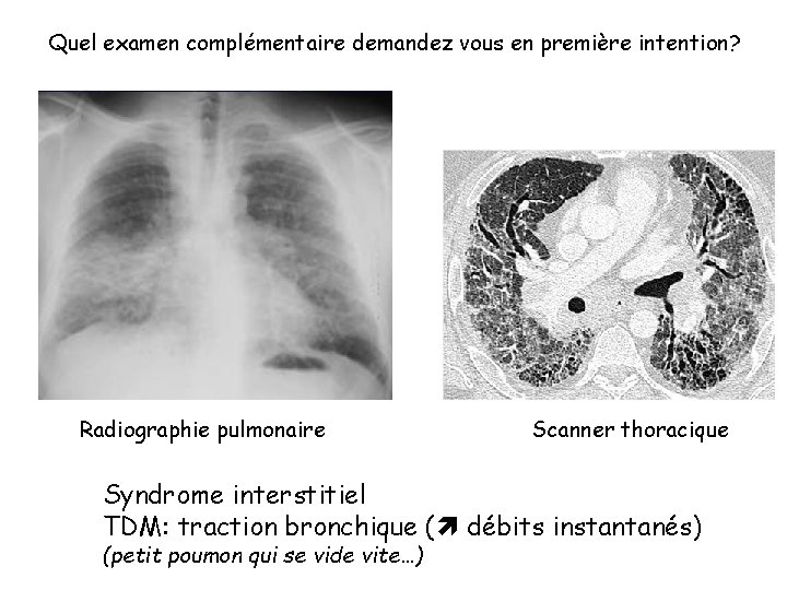 Quel examen complémentaire demandez vous en première intention? Radiographie pulmonaire Scanner thoracique Syndrome interstitiel