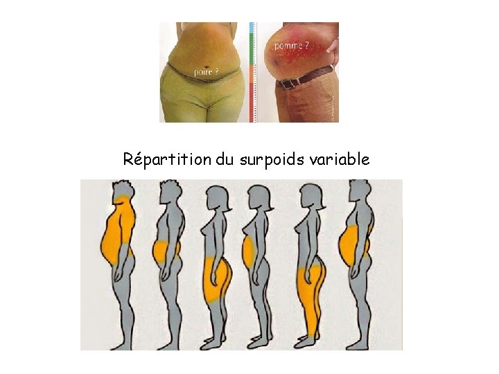 Répartition du surpoids variable 