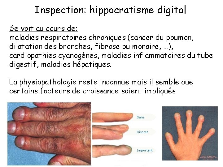 Inspection: hippocratisme digital Se voit au cours de: maladies respiratoires chroniques (cancer du poumon,