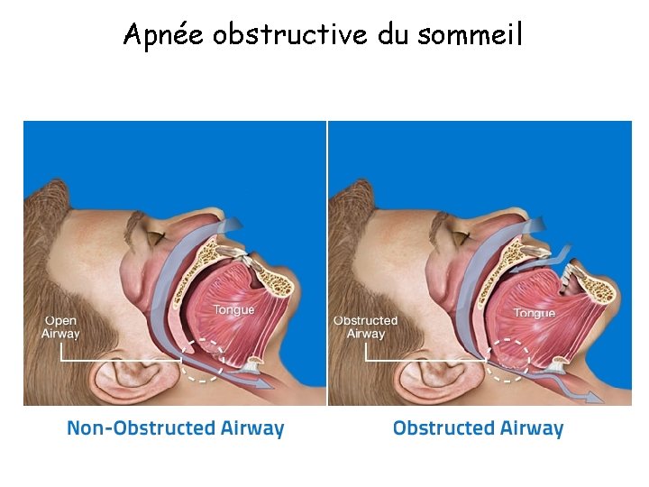 Apnée obstructive du sommeil 