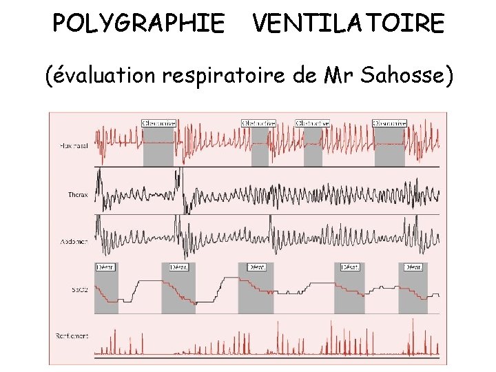 POLYGRAPHIE VENTILATOIRE (évaluation respiratoire de Mr Sahosse) 