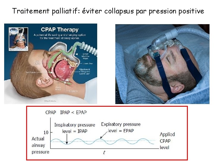 Traitement palliatif: éviter collapsus par pression positive 