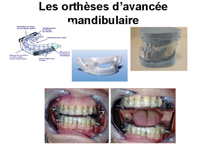 Les orthèses d’avancée mandibulaire 