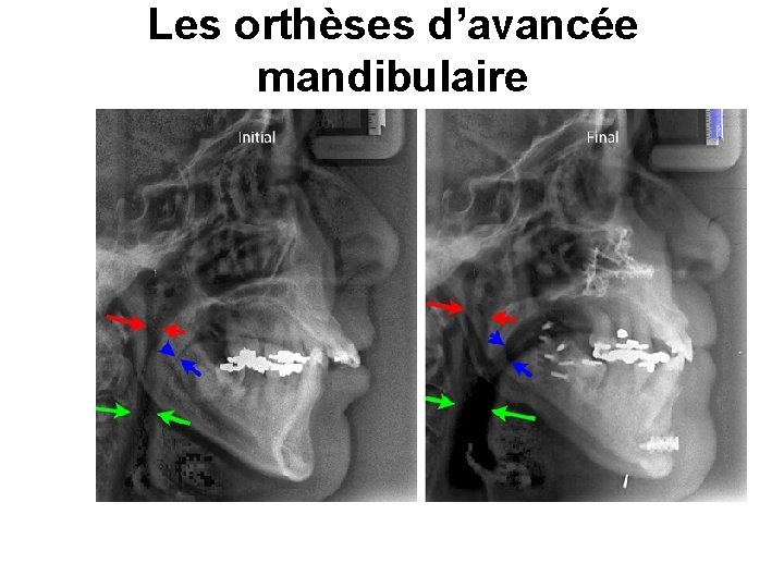 Les orthèses d’avancée mandibulaire 