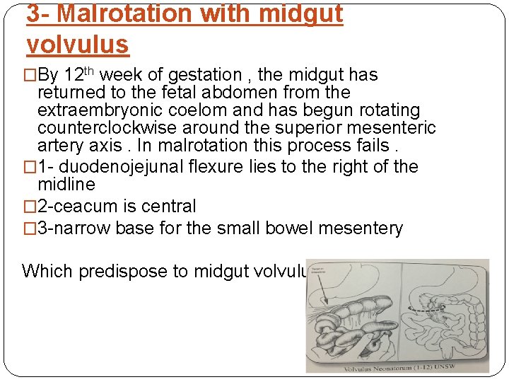 3 - Malrotation with midgut volvulus �By 12 th week of gestation , the
