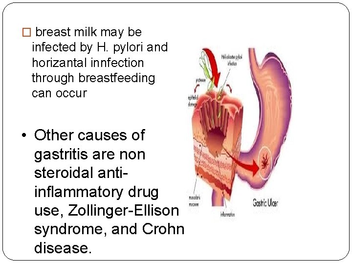 � breast milk may be infected by H. pylori and horizantal innfection through breastfeeding