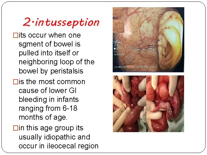 2. intusseption �its occur when one sgment of bowel is pulled into itself or