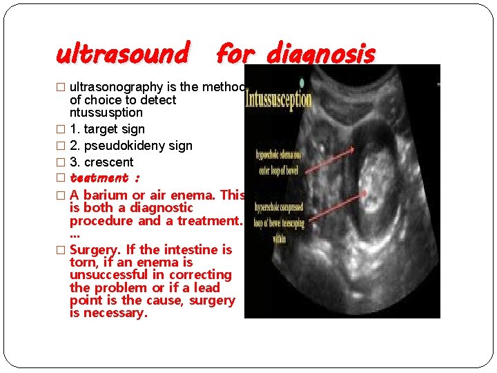ultrasound for diagnosis � ultrasonography is the method of choice to detect ntussusption �