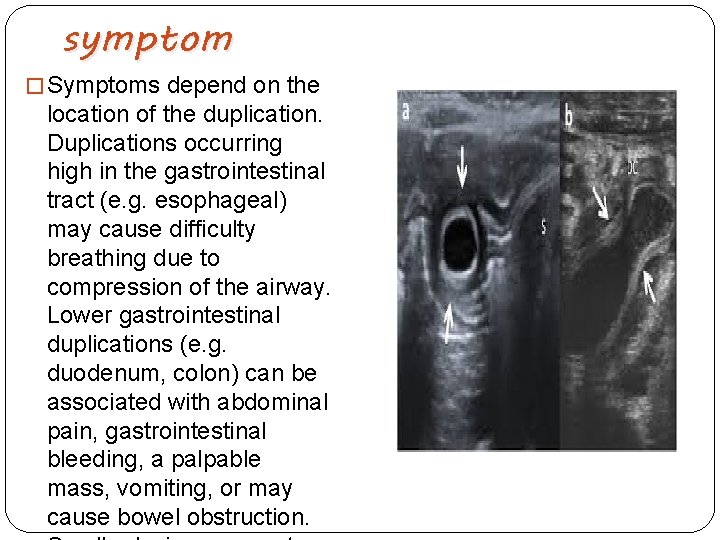 symptom � Symptoms depend on the location of the duplication. Duplications occurring high in