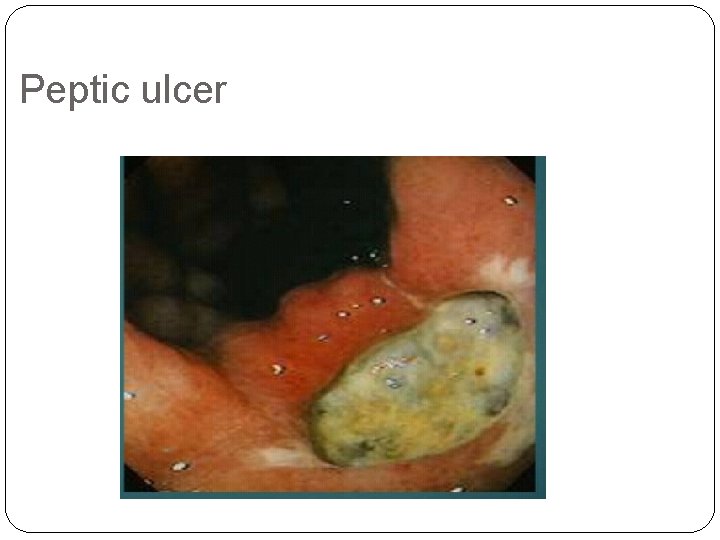 Peptic ulcer 